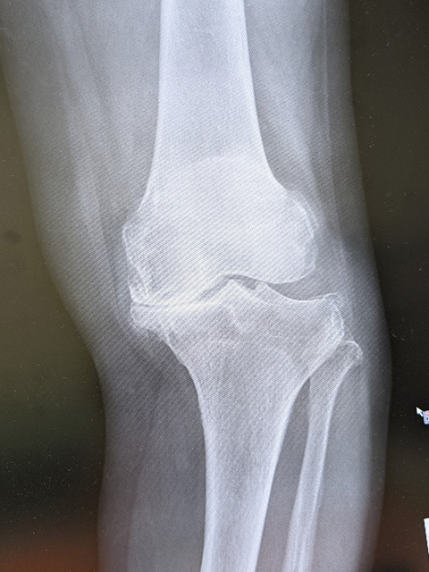 人工膝関節全置換術 (TKA)