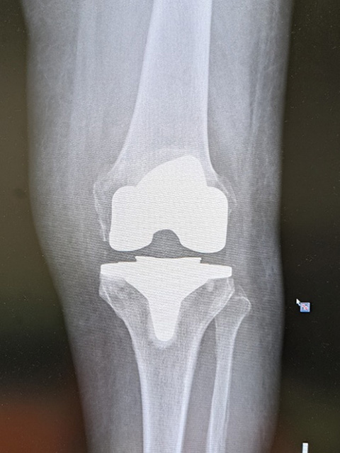 人工膝関節全置換術 (TKA)