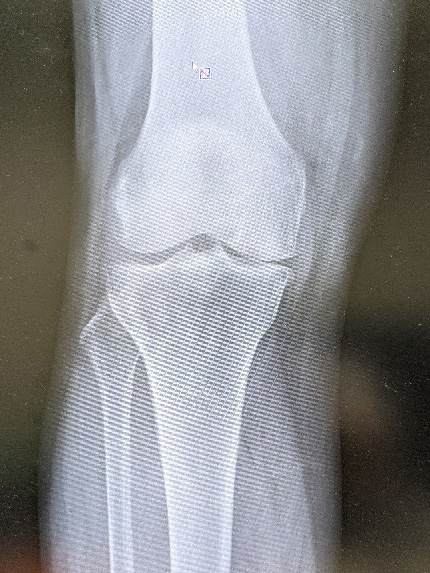 単顆部膝関節置換術 (UKA)